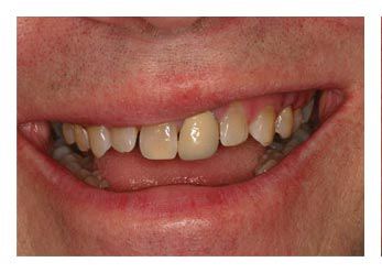 Upper Cosmetic Crowns