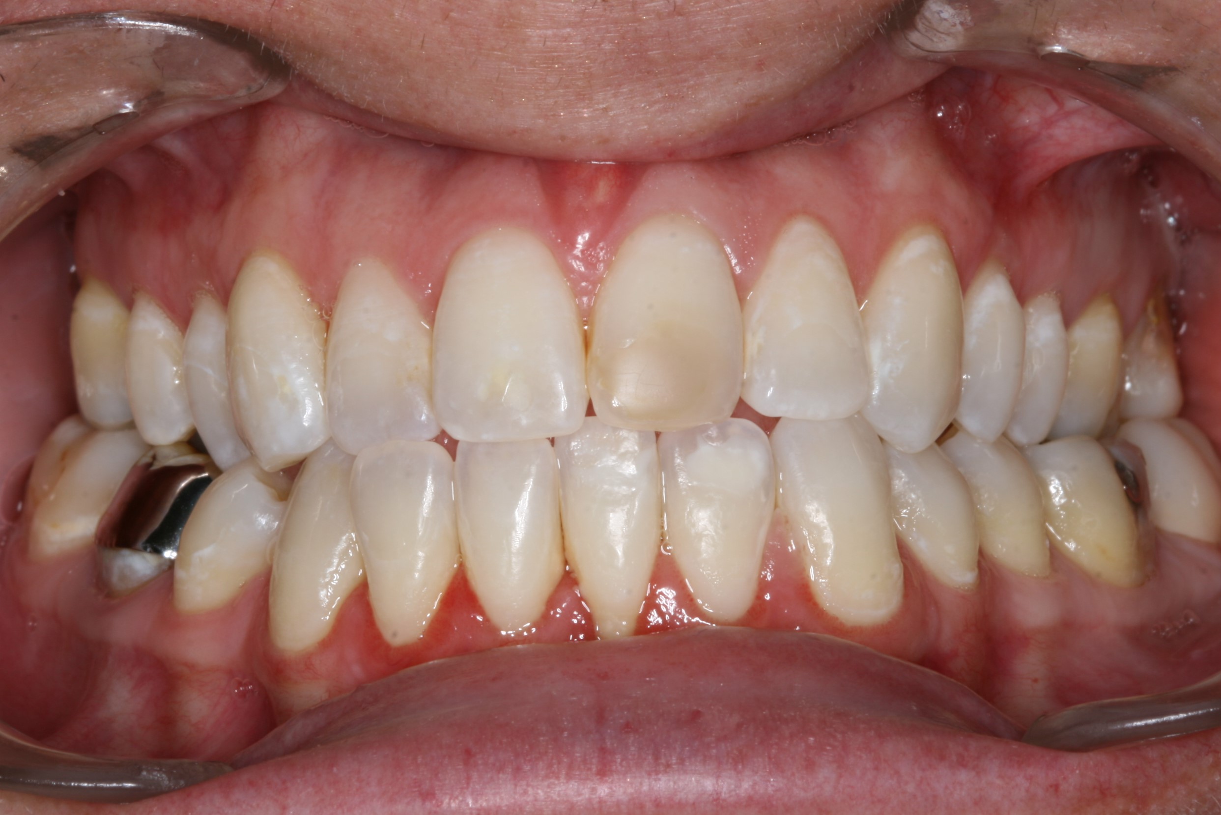 ICON Bleaching – no drilling, no anesthesia (lower left treated)